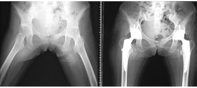 両側股関節の外転屈曲位での完全強直例写真
