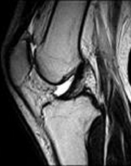 MRI