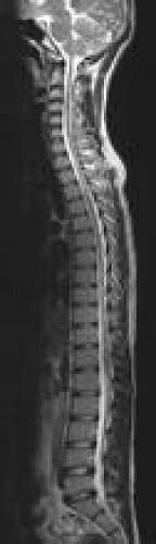 MRI
