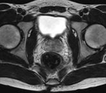 MRI