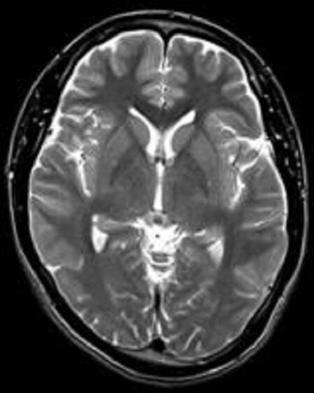MRI