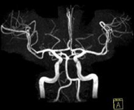 MRI