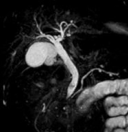 MRI