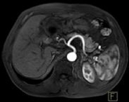 MRI