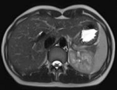 MRI