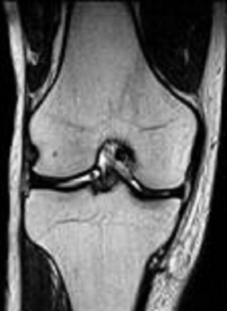 MRI